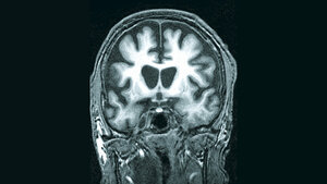 Atrophie bestimmter Hirnregionen