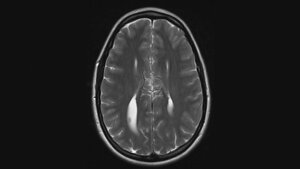 Anomalien und Normvarianten – Zerebrale Veränderungen 4.4