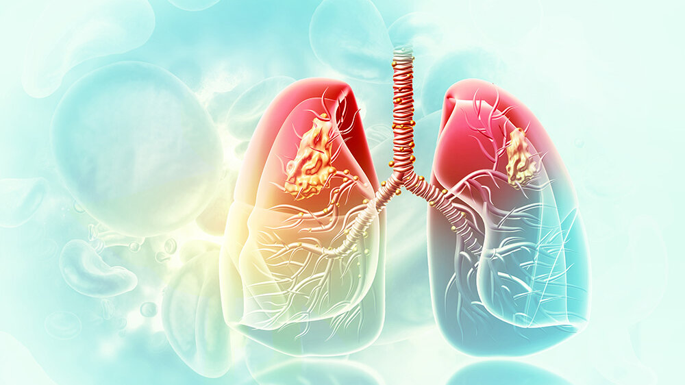 nicht-kleinzelliges Lungenkarzinom