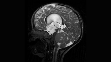 Medulloblastom_MRT_Hellerhoff_Wikimedia.jpg MRT-Aufnahme eines Medulloblastoms