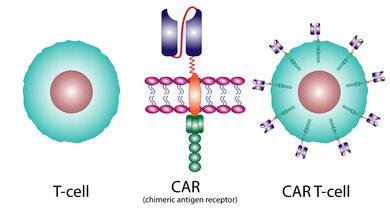 CAR_T_Zell.jpg CAR-T-Zell-Therapie