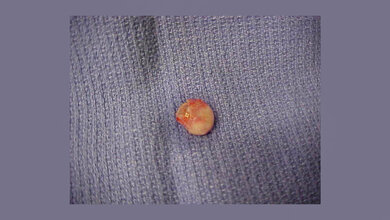 Leere Zyste von der Kopfhaut einer Frau