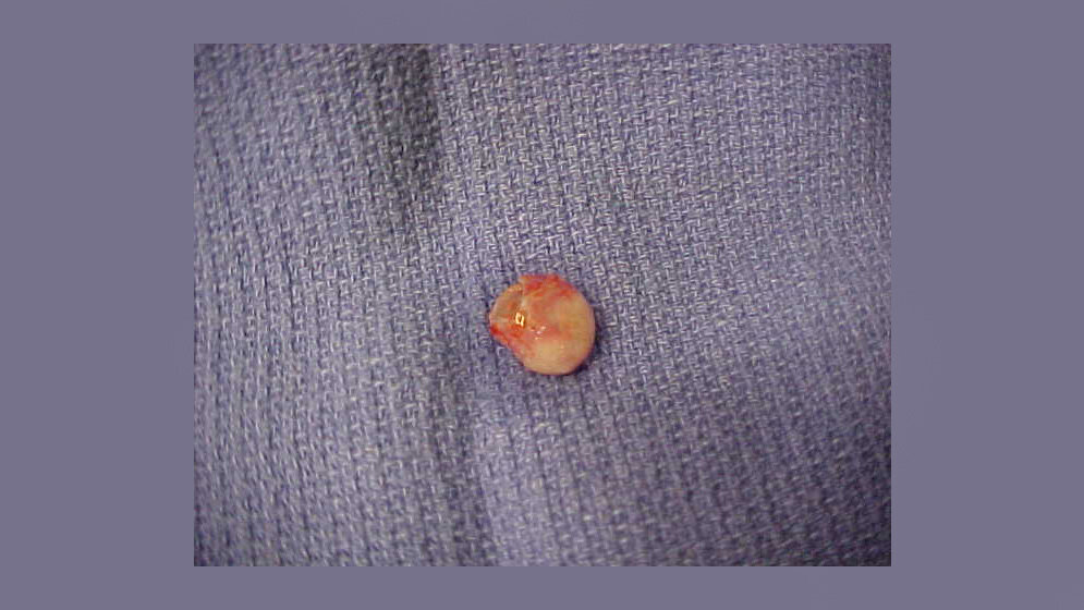 Leere Zyste von der Kopfhaut einer Frau