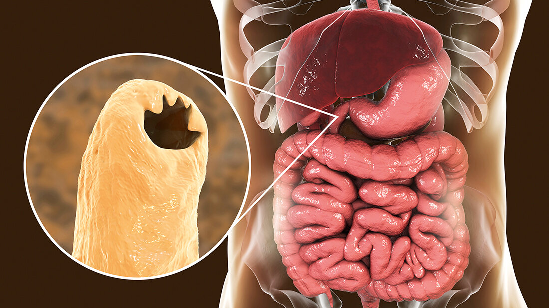 Title picture for the case study on a hookworm infection