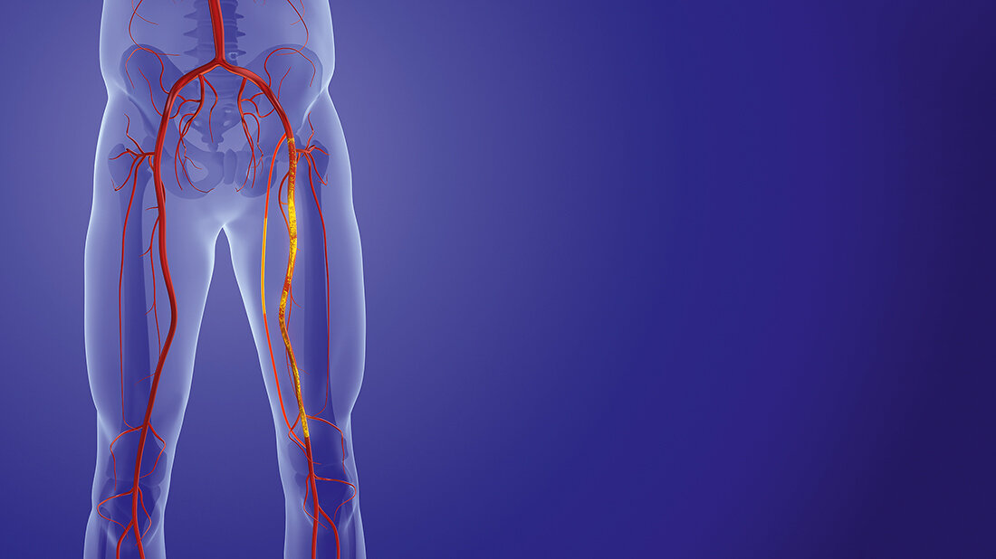 Schematische Darstellung der Beinarterien