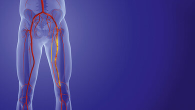 Nicht immer ist der Rücken schuld! Schematische Darstellung der Beinarterien