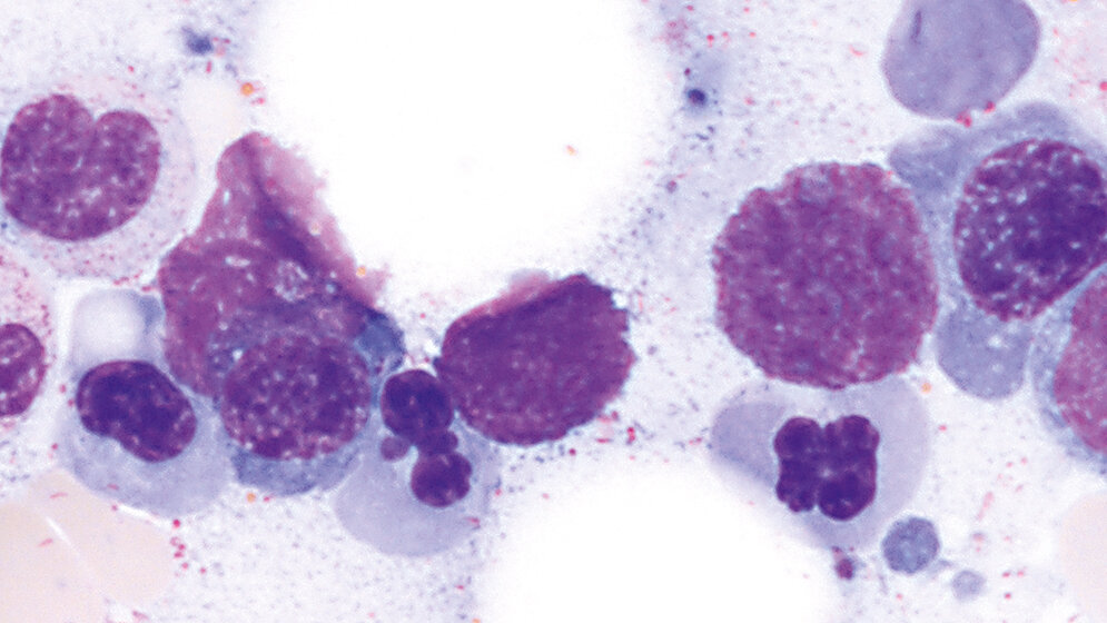 Dysplastische Veränderungen der Hämatopoese (Teil 1)