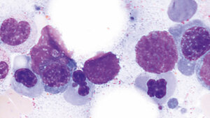 Dysplastische Veränderungen der Hämatopoese (Teil 1)