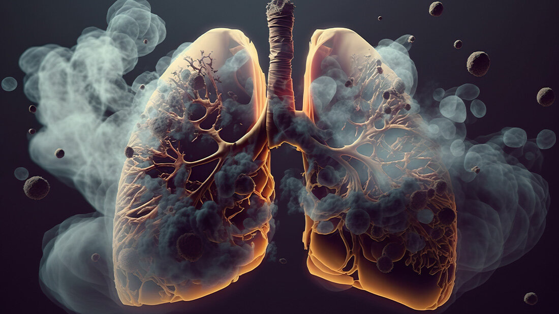 Pneumologen plädieren für Lungekrebs-Screening als Regelleistung