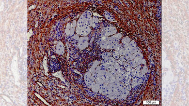 Aktivierte_Fibroblasten_braun_UMM.jpg Aktivierte Fibroblasten und Entzündung