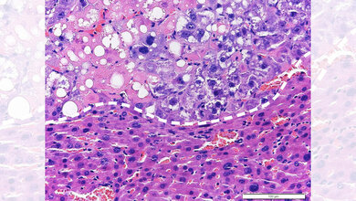 Lebertumor unterm Mikroskop