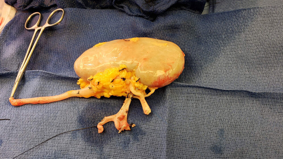 Niere_eines_Lebendspenders_Von_Rmarlin_Eigenes_Werk_CC_BY_SA_4_0_wikimedia.jpg Niere eines Lebendspenders