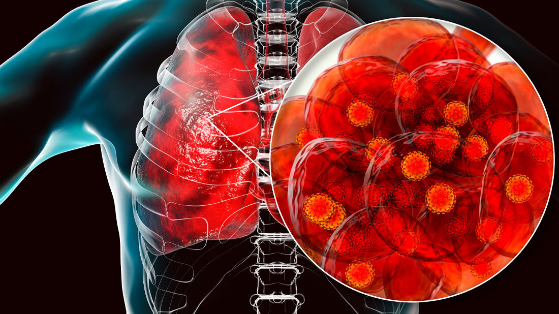 Symbolisches Bild, das SARS-CoV-2-Viren in der Lunge zeigt