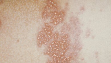 d-010-06-01-c-herpeszoster-rgb.jpg Herpes zoster