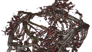 Herzkranzgefaesse.jpg Arteriosklerose