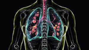 Grafische Darstellung der Mukoviszidose in einem transparenten Brustkorb