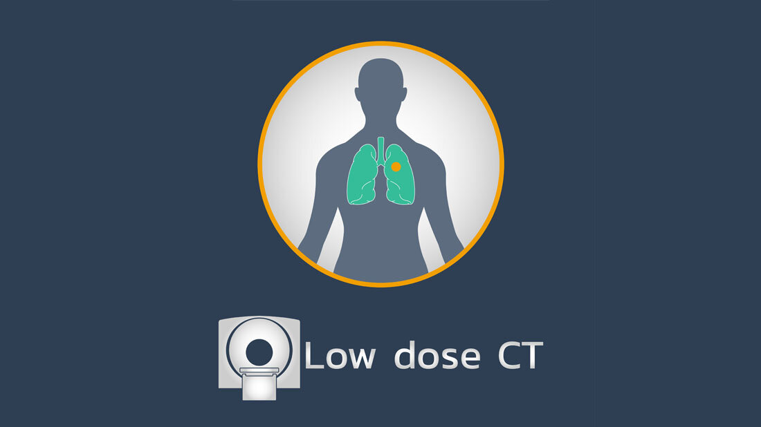 low_dose_ct.jpg Lungenkrebs-Screening per Low-Dose-CT