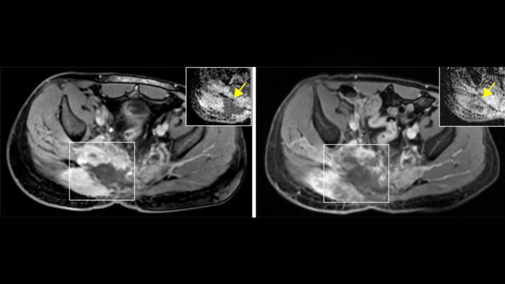 Patient_mit_fortgeschrittenem_Chordom_NCT_Heidelberg.jpg Chordom