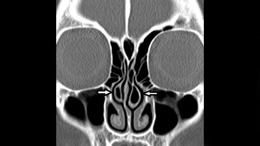 Bildgebende Verfahren Anomalien und Normvarianten – Skelettale Veränderungen 3.10: Concha bullosa