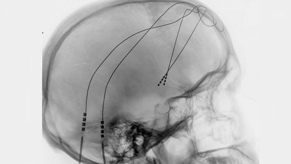 Elektroden im Nucleus accumbens