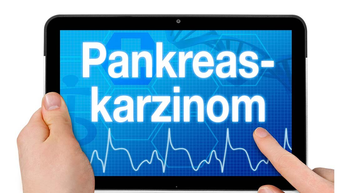 Neue Therapieoptionen gegen Bauchspeicheldrüsenkrebs