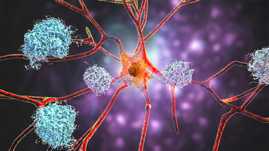 Alzheimer_Antikoerper_Donanemab.jpg Neuer Alzheimer-Antikörper bremst kognitiven Abbau, hat aber starke Nebenwirkungen