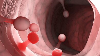 DarmkrebsIquickonline.jpg IQWiG bewertet internationale Empfehlungen zum Darmkrebsscreening