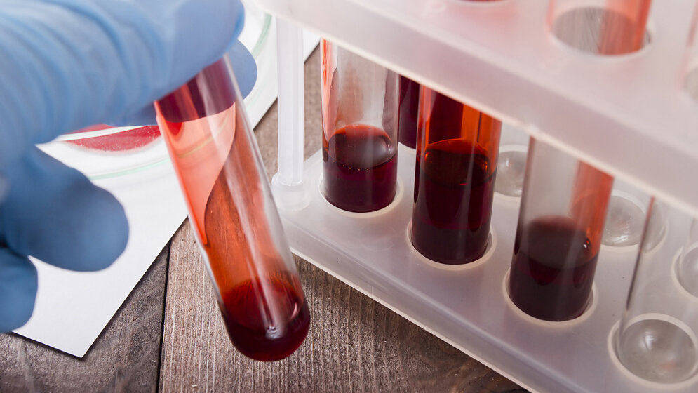 Nichtinvasive pränatale Diagnostik