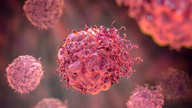 Immuntherapie verbessert Prognose bei Gallengankrebs