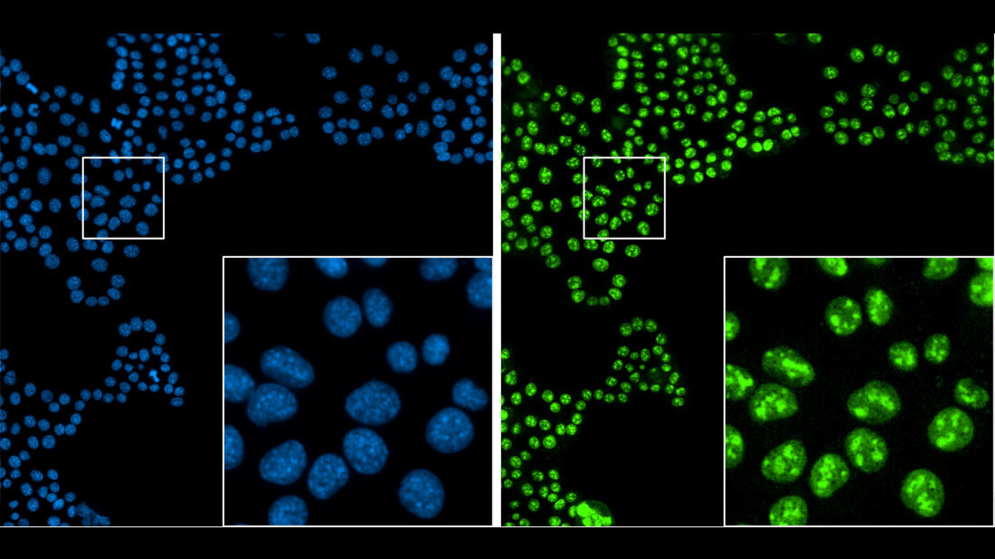 Immunfluoreszenzaufnahme_Bauchspeicheltumordruesenzellen.jpg Immunfluoreszenzaufnahme von Bauchspeicheldrüsentumorzellen in Zellkultur.