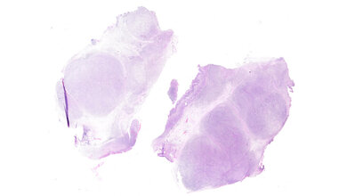 Lymphom.jpg Gewebeschnitt eines Lymphoms