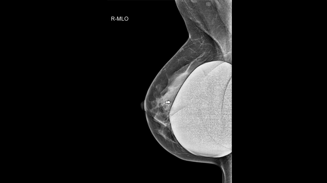Mamma-Implantat rechts (Pfeil) in der Mammografie, typische homogene Verschattung