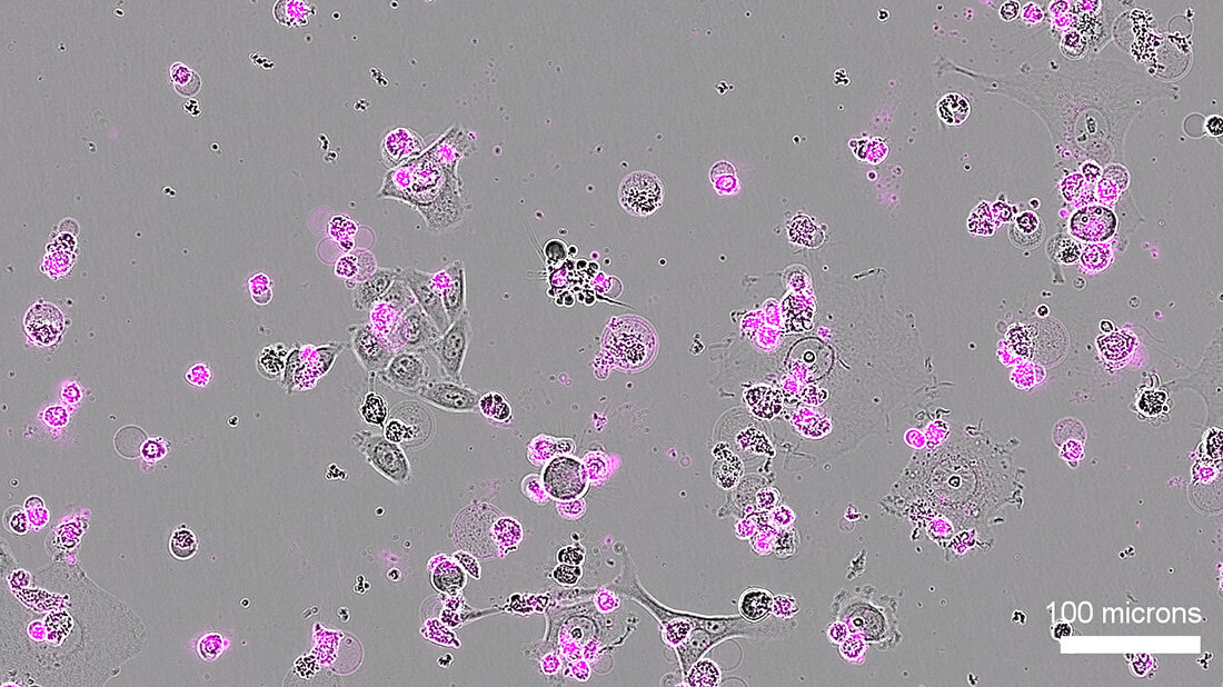 Mikroskopie_Gebaermutterhalskrebs_Apoptose.jpg Mikroskopisches Bild von Gebärmutterhalskrebszellen, lila Punkte zeigen Apoptosemarker
