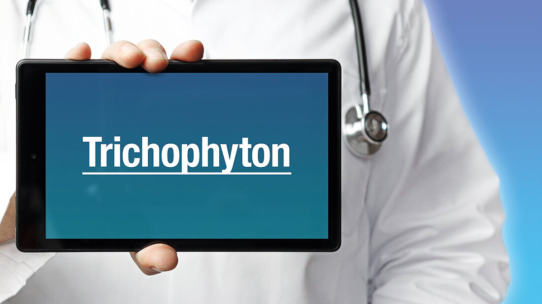 Trichophyton indotineae Titelbild des Fachbeitrags zur globalen Ausbreitung des multiresistenten Hautpilzes Trichophyton indotineae