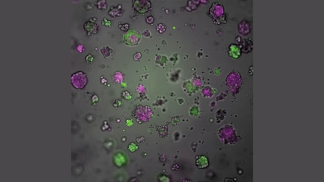 Brustkrebs-Organoide
