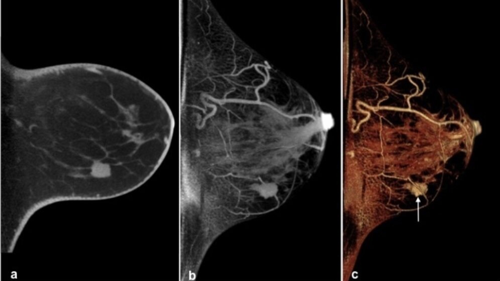 Cone-Beam Brust-CT