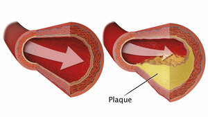 Digitale Subtraktionsangiographie 