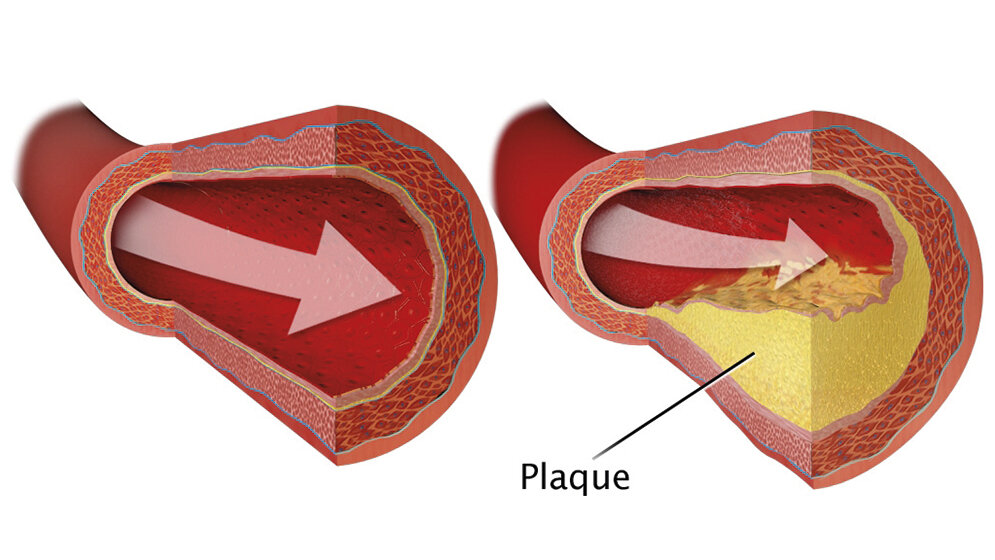 Plaque Development Vascular Imaging