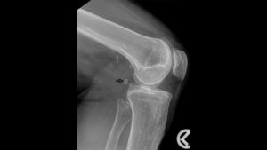 Röntgenbild linkes Kniegelenk seitlich