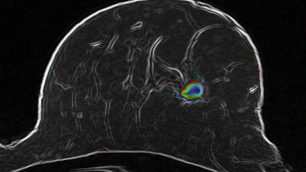 optimierte diffusionsgewichtete MRT-Bildaufnahmetechnik