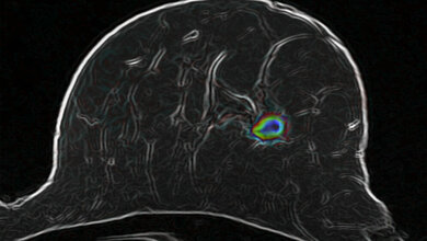optimierte diffusionsgewichtete MRT-Bildaufnahmetechnik