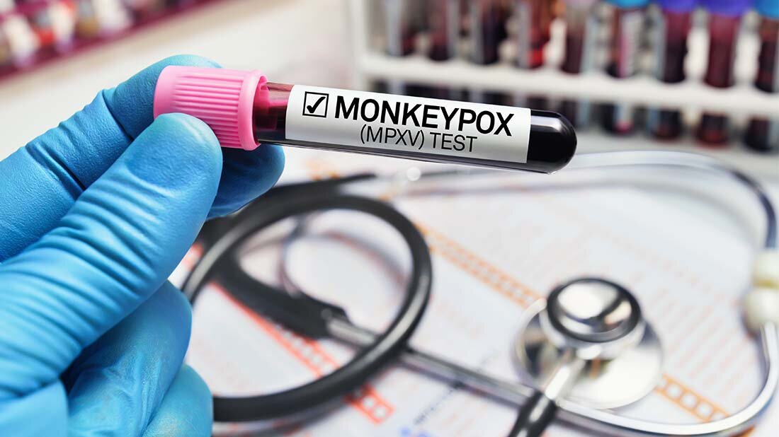 Affenpocken.jpg Das Robert Koch Institut erwartet in Deutschland weitere Affenpocken-Fälle.