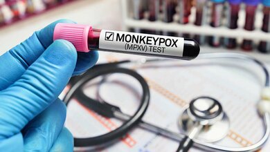 Das Robert Koch Institut erwartet in Deutschland weitere Affenpocken-Fälle.