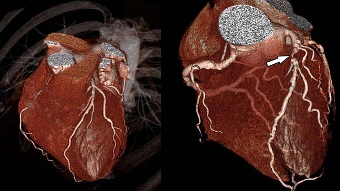 Computertomografie als Alternative zum Herzkatheter