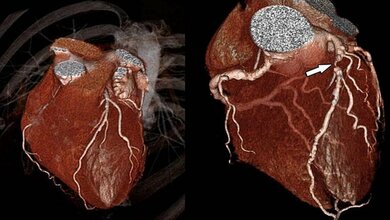 Computertomografie als Alternative zum Herzkatheter