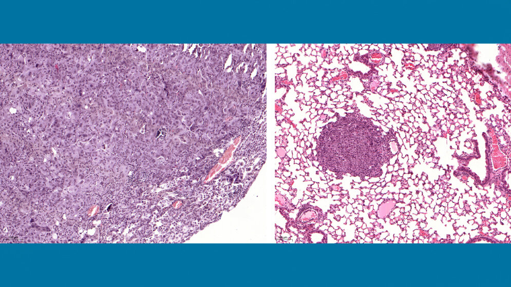 Links ein Lungentumor, der USP28 exprimiert