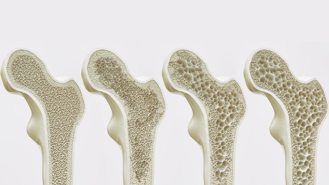 osteoporose.jpg