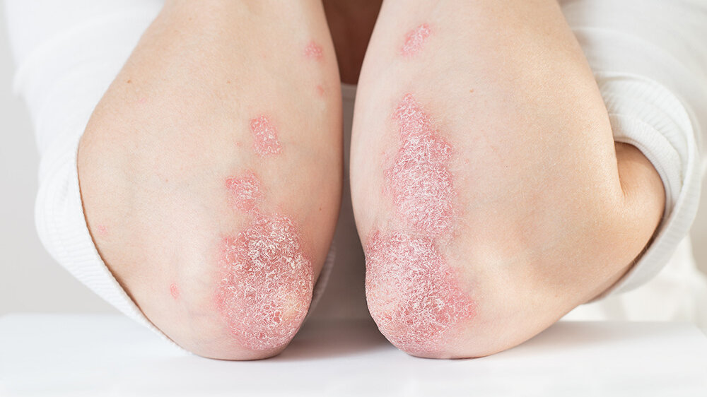 PSoriasis