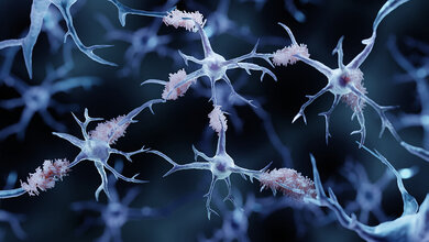 Ablagerung_Beta_Amyloid.jpg Beta-Amyloid Ablagerungen