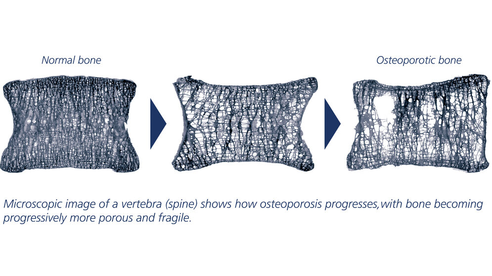 Osteoporose